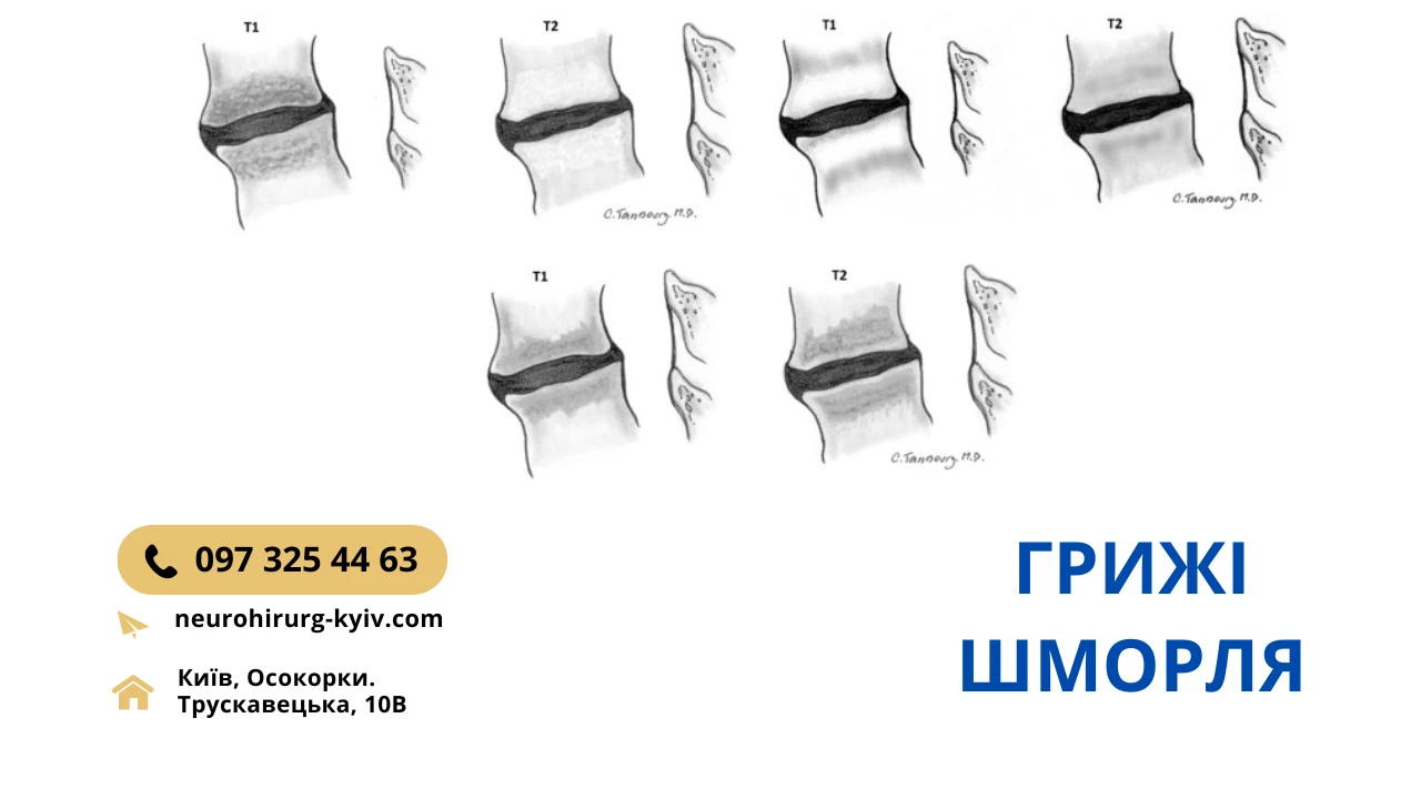 Грижа Шморля Діагностика та Лікування Київ - консультує лікар нейрохірург Скіжа Наталія