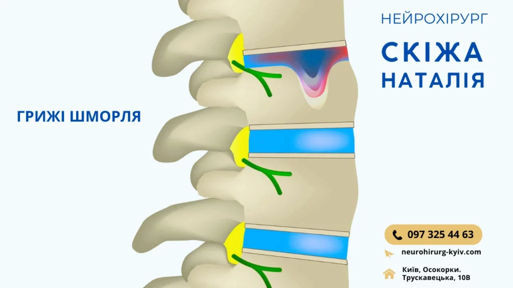 Грижа Шморля Діагностика та Лікування - консультує лікар нейрохірург Скіжа Наталія 2024 Київ