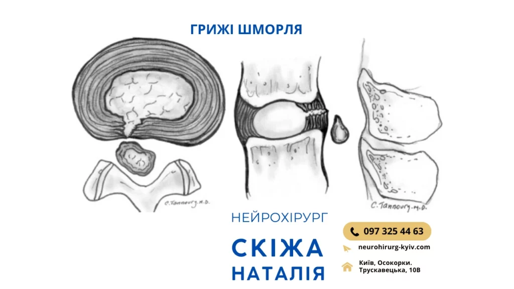 Грижа Шморля Діагностика та Лікування - консультує лікар нейрохірург Скіжа Наталія - НЕЙРОХІРУРГ КИЇВ