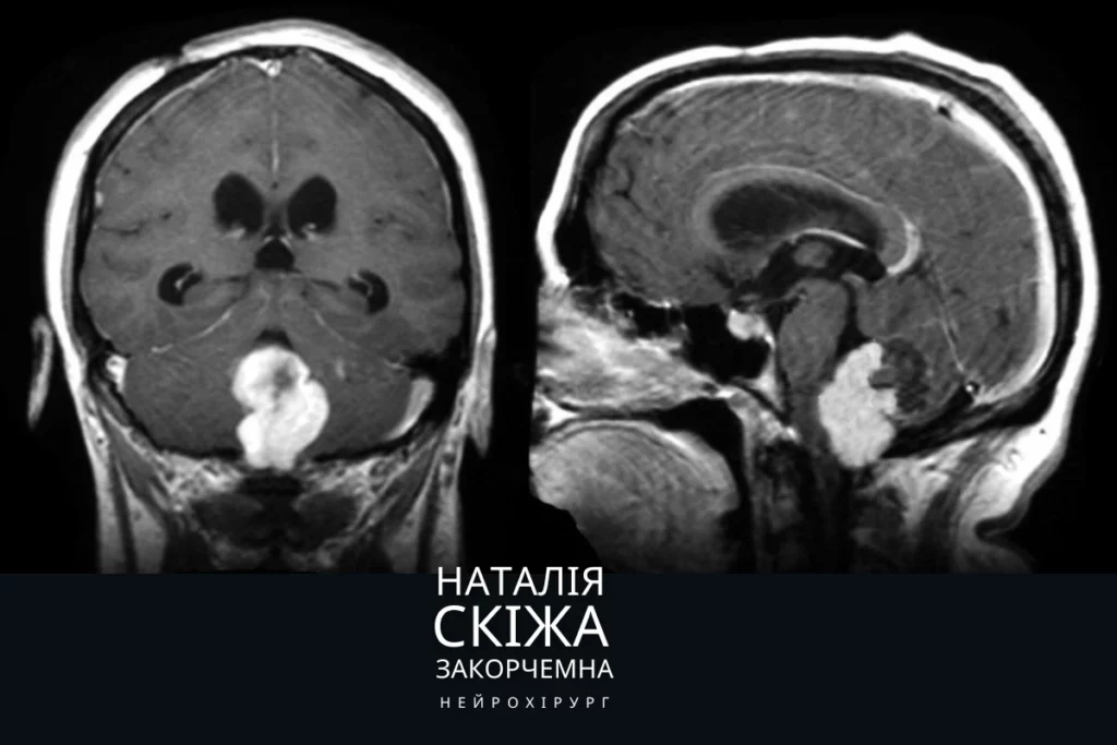 Епендимома: Лікування в Києві нейрохірург Наталія Скіжа