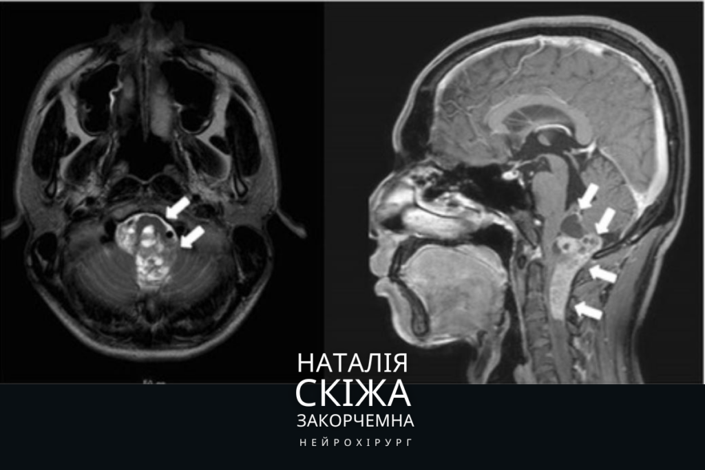 Епендимома: Лікування в Києві нейрохірург Наталія Скіжа