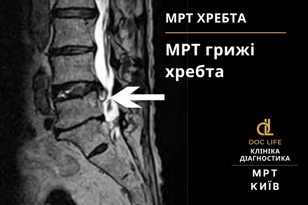 Інвалідність при міжхребцевій грижі в Україні: критерії, діагностика та лікування - НЕЙРОХІРУРГ КИЇВ