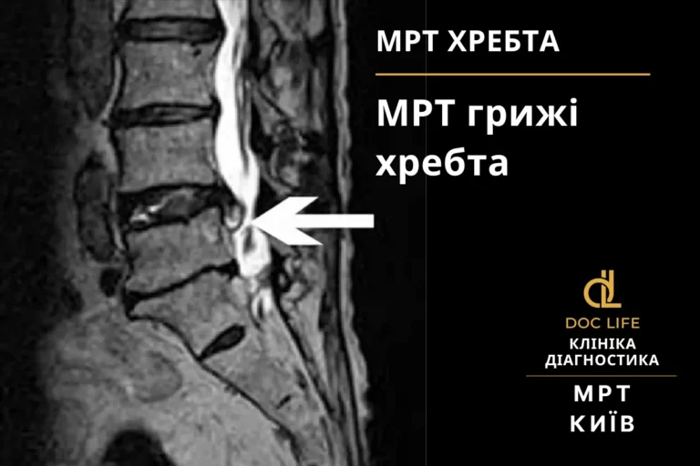 Інвалідність при міжхребцевій грижі в Україні: критерії, діагностика та лікування