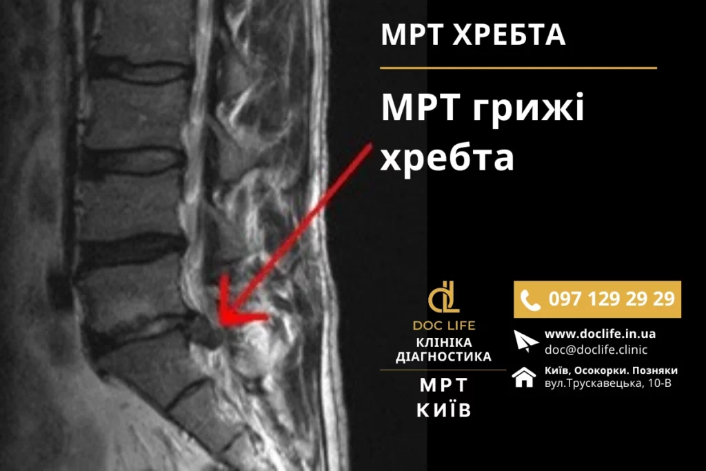 Інвалідність при міжхребцевій грижі в Україні: критерії, діагностика та лікування