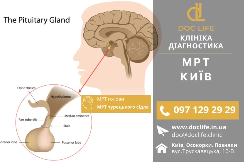 Турецьке сідло головного мозку