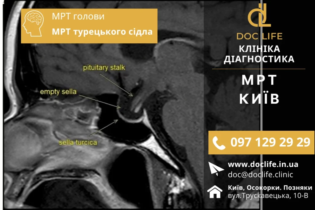 Порожнє турецьке сідло головного мозку. Діагностика МРТ турецького сідла