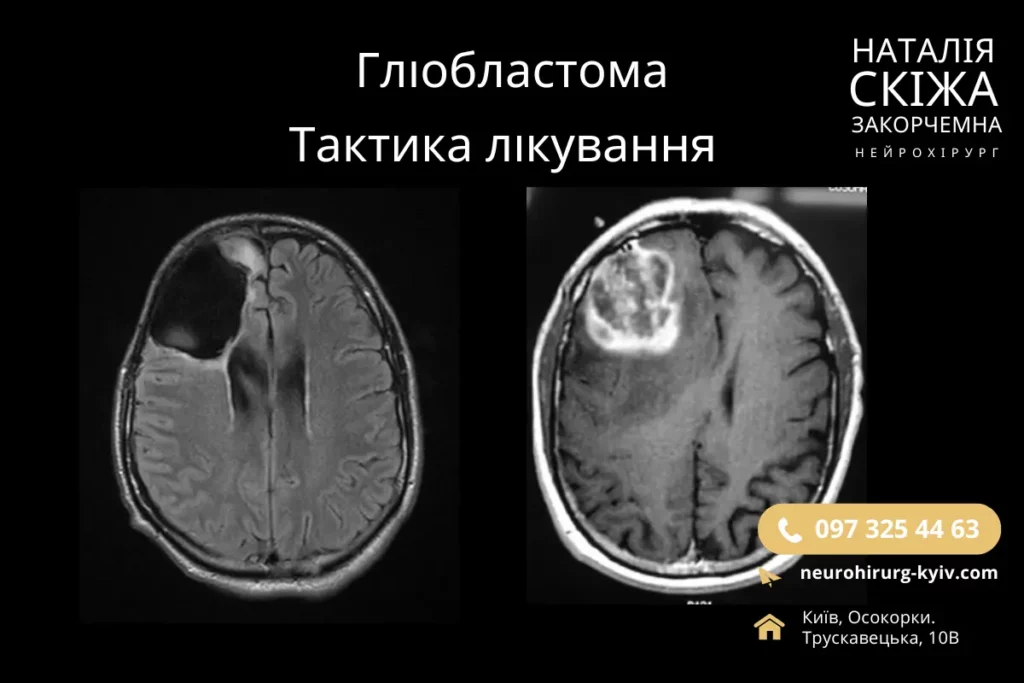 Гліобластома. Київ Лікування гліобластоми консультує нейрохірург Скіжа Наталія - НЕЙРОХІРУРГ КИЇВ