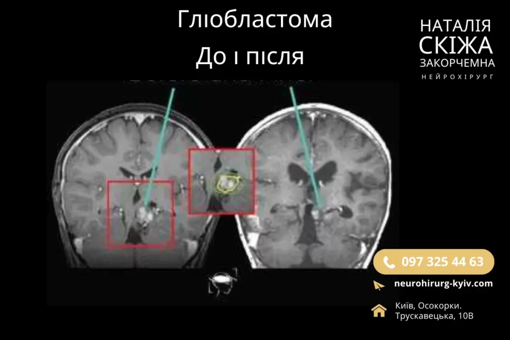 Гліобластома