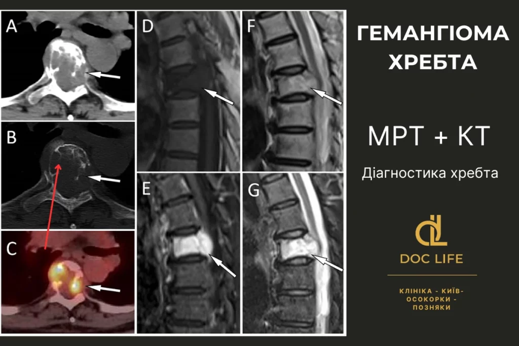 Методи діагностики гемангіома тіла хребта: думки експерта