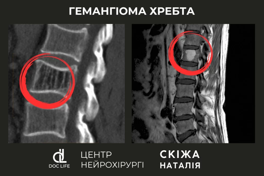 Гемангіома хребта: Діагностика, Лікування Гемангіоми Тіла Хребця - НЕЙРОХІРУРГ КИЇВ