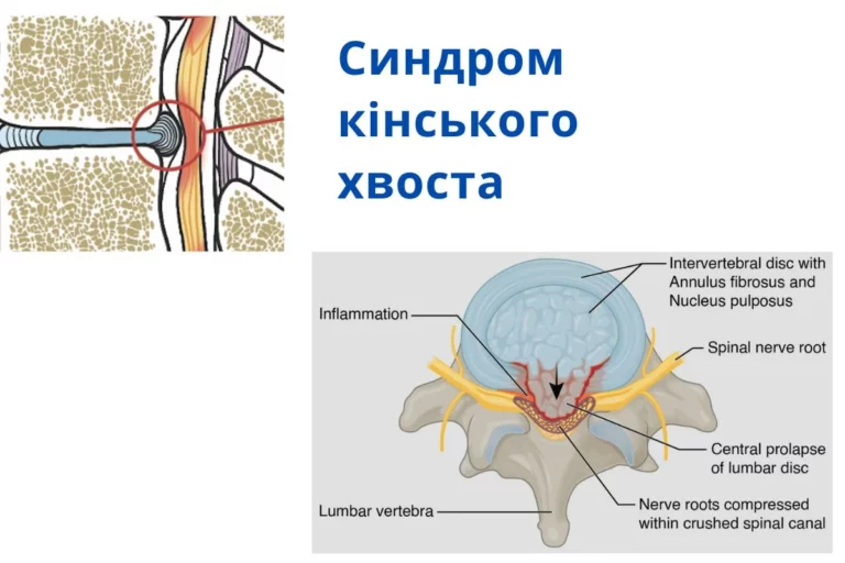 синдрому кінського хвоста