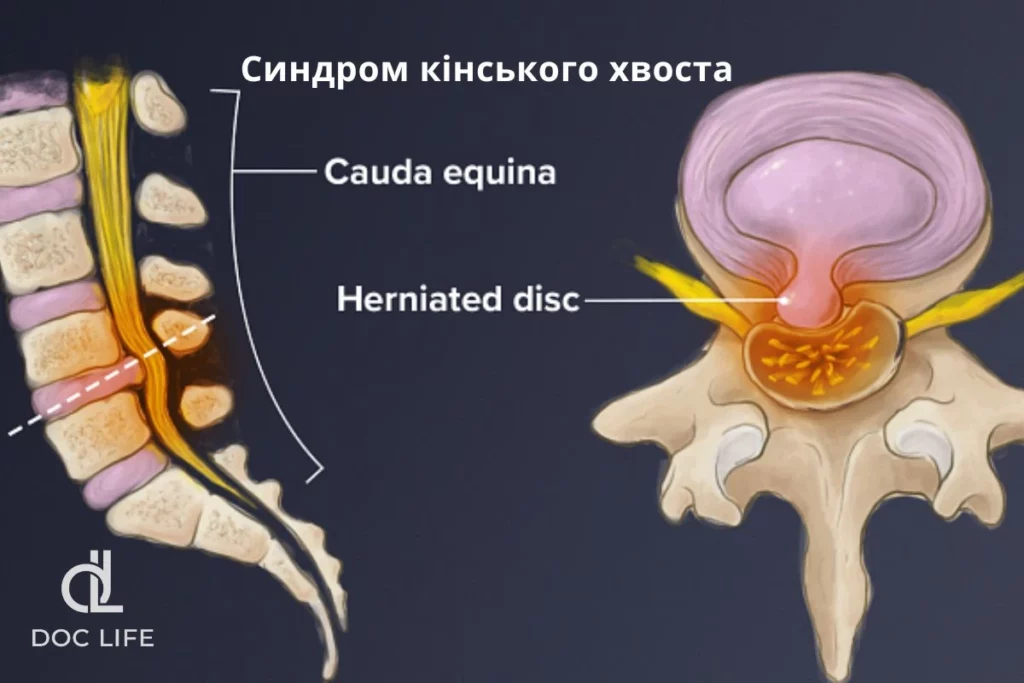 синдрому кінського хвоста