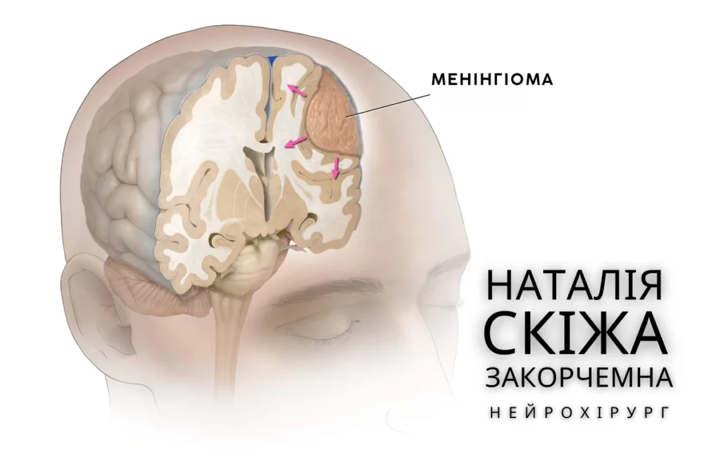 Менінгіома- сучасні методи діагностики та лікування 4