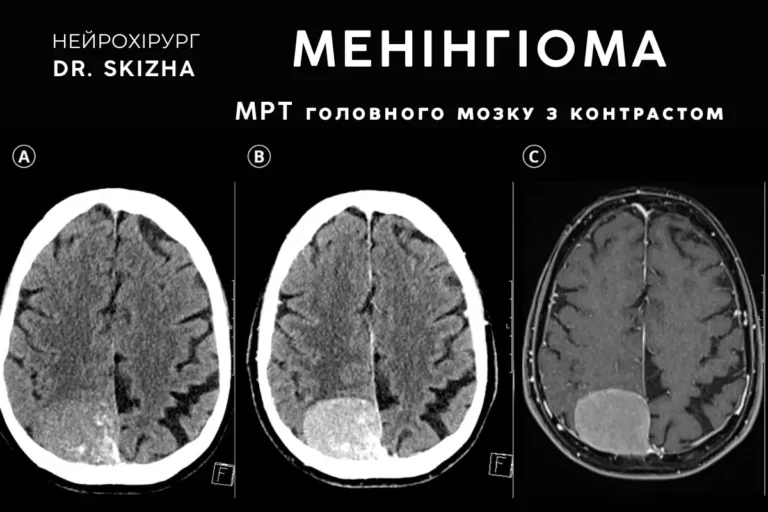 Менінгіома- сучасні методи діагностики та лікування 4