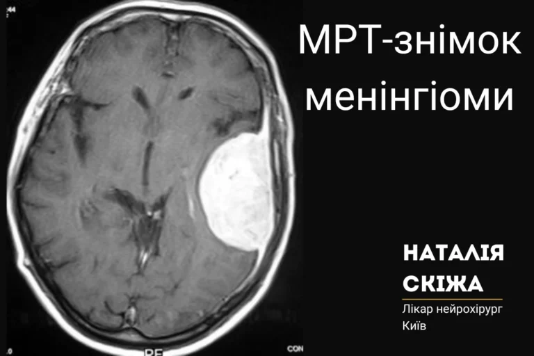 Менінгіома головного мозку Наталія Скіжа нейрохірург Київ 1