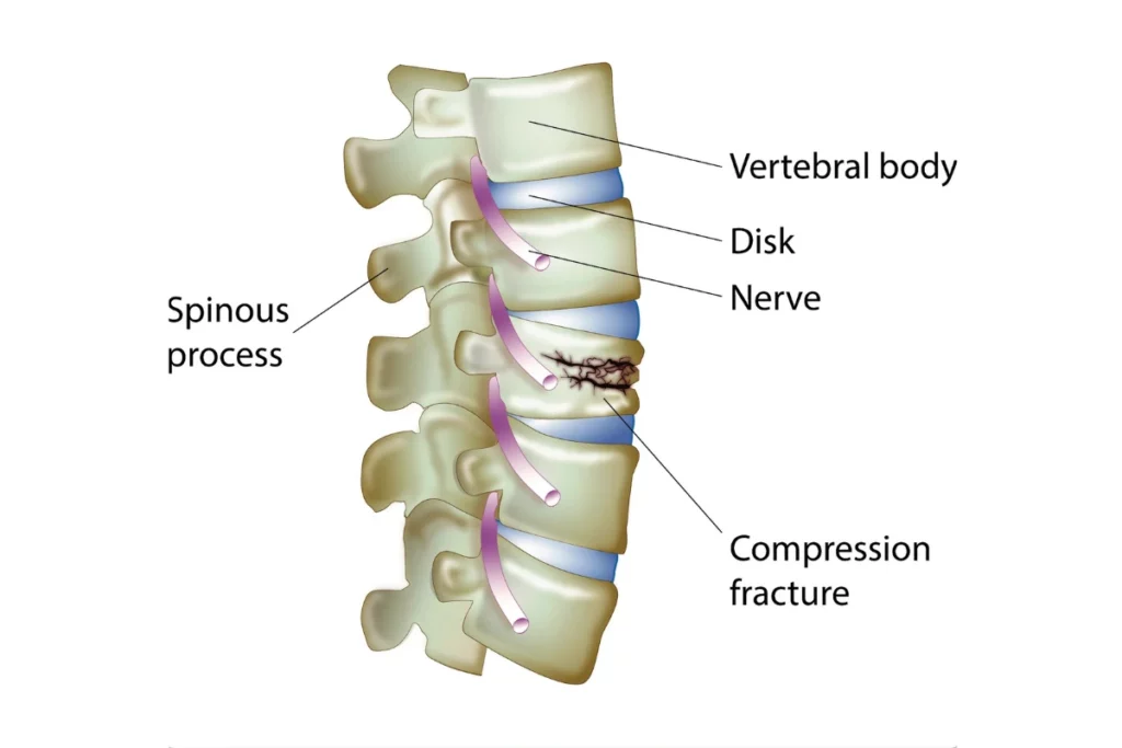 Методи лікування компресійного перелому хребта