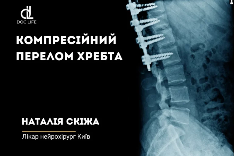 Компресійний перелом хребта: причини, наслідки та сучасні методи лікування Компресійні переломи хребта виникають переважно через остеопороз