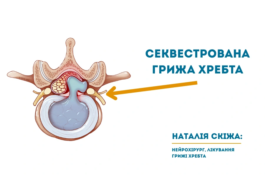Секвестрована грижа хребта - Хірургічне лікування (операція) Секвестрована грижа хребта - Хірургічне лікування (операція)