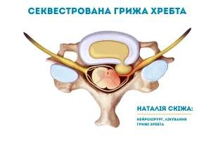 Секвестрована грижа хребта Києві 2