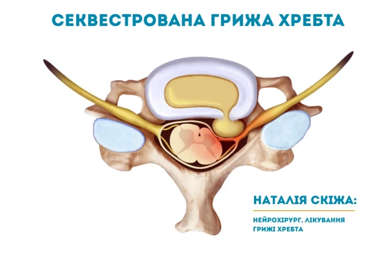 Секвестрована грижа хребта Києві 2