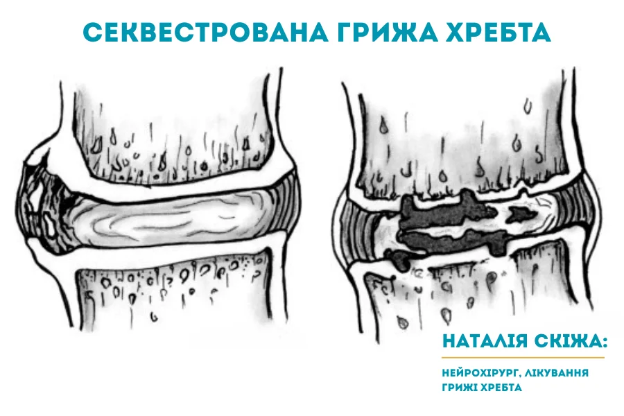 Секвестрована грижа хребта Києві 4 Секвестрована грижа хребта Києві 4