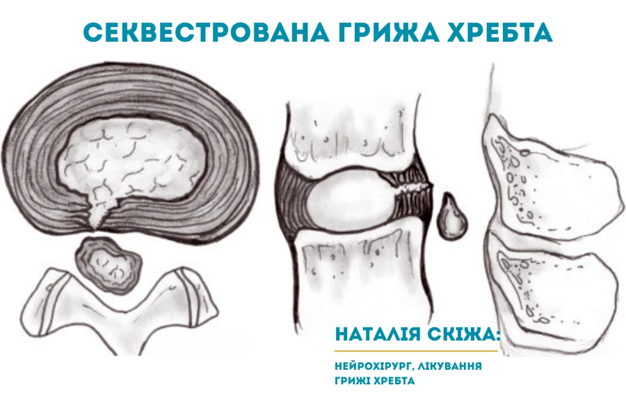 Визначення та патофізіологія секвестрованої грижі Визначення та патофізіологія секвестрованої грижі
