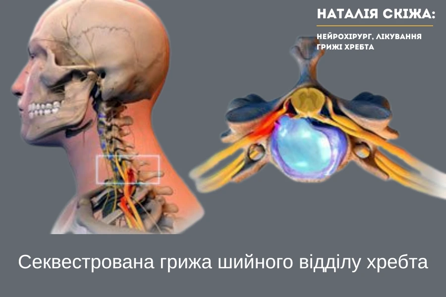 Можливі ускладнення секвестрованої грижі Можливі ускладнення секвестрованої грижі