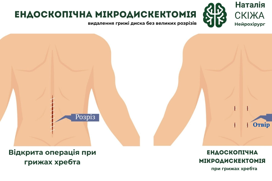 Ендоскопічна мікродискектомія – новітній підхід 2025 року Ендоскопічна мікродискектомія – новітній підхід 2025 року