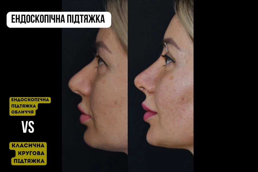 Ендоскопічна підтяжка обличчя vs класична кругова підтяжка – у чому різниця?