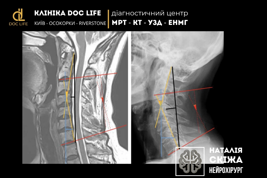 Вимірювання шийного відділу хребта, показані на МРТ (зліва) та рентгенограмі (справа). Червоні суцільні та пунктирні лінії – вимірювання кутів Cobb на рівні C2–C7. Жовті лінії – абсолютний ротаційний кут C2–C7. Чорні лінії – вимірювання за методом Бордена (Borden’s method). Сині лінії – вимірювання положення сагітальної вертикальної осі C2–C7. Вимірювання шийного відділу хребта, показані на МРТ (зліва) та рентгенограмі (справа).
Червоні суцільні та пунктирні лінії – вимірювання кутів Cobb на рівні C2–C7.
Жовті лінії – абсолютний ротаційний кут C2–C7.
Чорні лінії – вимірювання за методом Бордена (Borden’s method).
Сині лінії – вимірювання положення сагітальної вертикальної осі C2–C7.