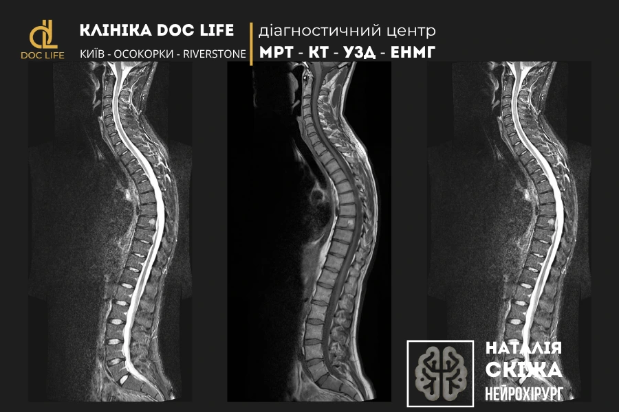 Що таке сколіоз? Що таке сколіоз?