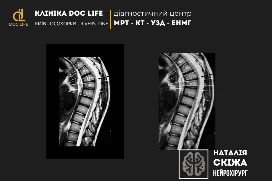 Діагностика кіфозу і сколіозу Діагностика кіфозу і сколіозу