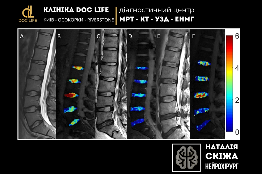 Морфологічні та композиційні МРТ міжхребцевих дисків поперекового відділу хребта Морфологічні та композиційні МРТ міжхребцевих дисків поперекового відділу хребта