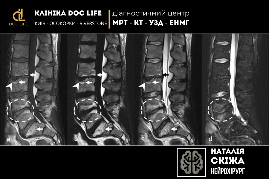 МРТ поперекового відділу хребта у 38-річного чоловіка: МРТ поперекового відділу хребта у 38-річного чоловіка: