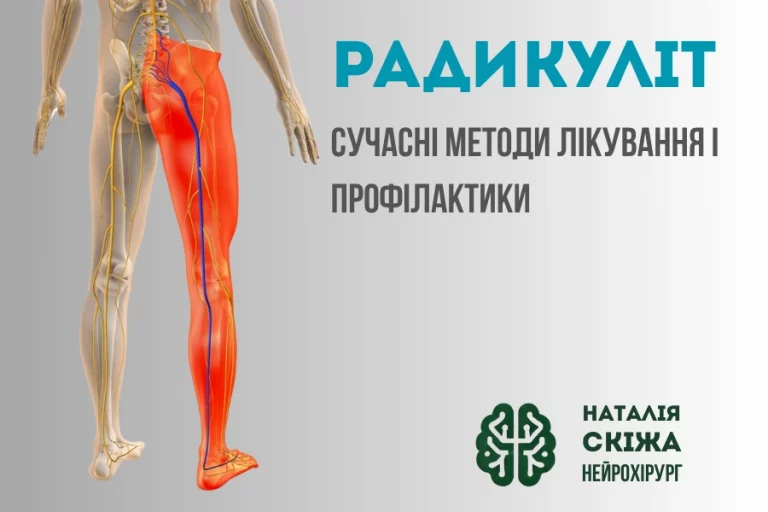 Радикуліт Наталія Скіжа нейрохїрург Київ 4