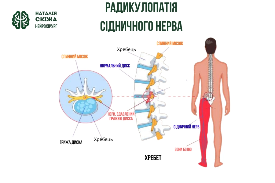 Радикуліт: сучасні методи лікування і профілактики Радикуліт: сучасні методи лікування і профілактики - Нейрохірург Наталія Скіжа Київ