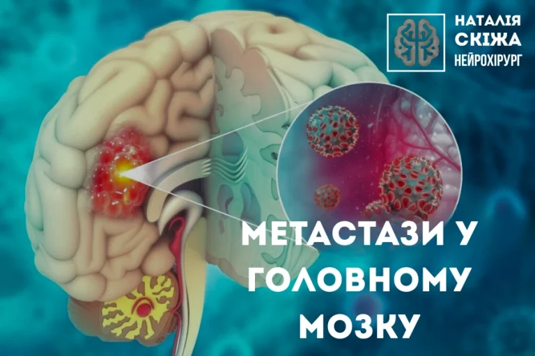 Метастази у головному мозку 2