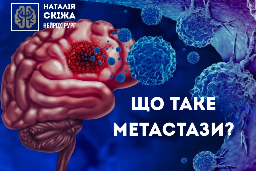Метастази у головному мозку: діагностика та можливості лікування Метастази у головному мозку: діагностика та можливості лікування