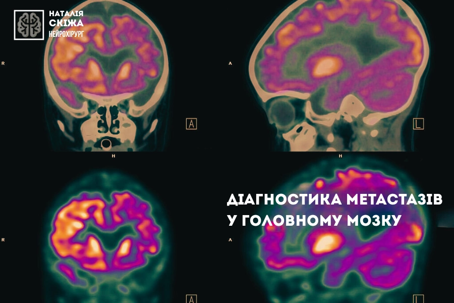 Лікар може призначити ПЕТ-КТ, КТ грудної клітки та КТ черевної порожнини, УЗД, лабораторні аналізи, які виявляють онкомаркери Лікар може призначити ПЕТ-КТ, КТ грудної клітки та КТ черевної порожнини, УЗД, лабораторні аналізи, які виявляють онкомаркери
