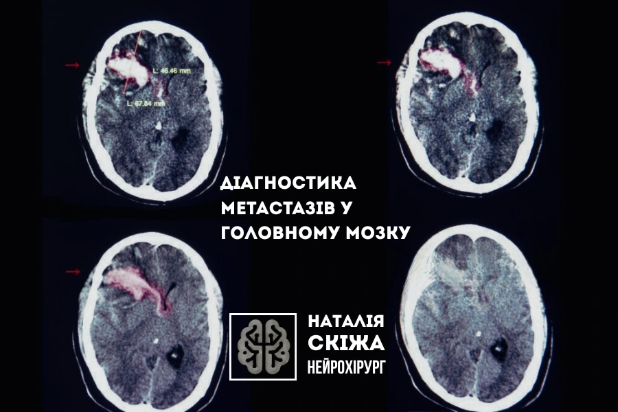 МРТ при метастазах головного мозку МРТ при метастазах головного мозку