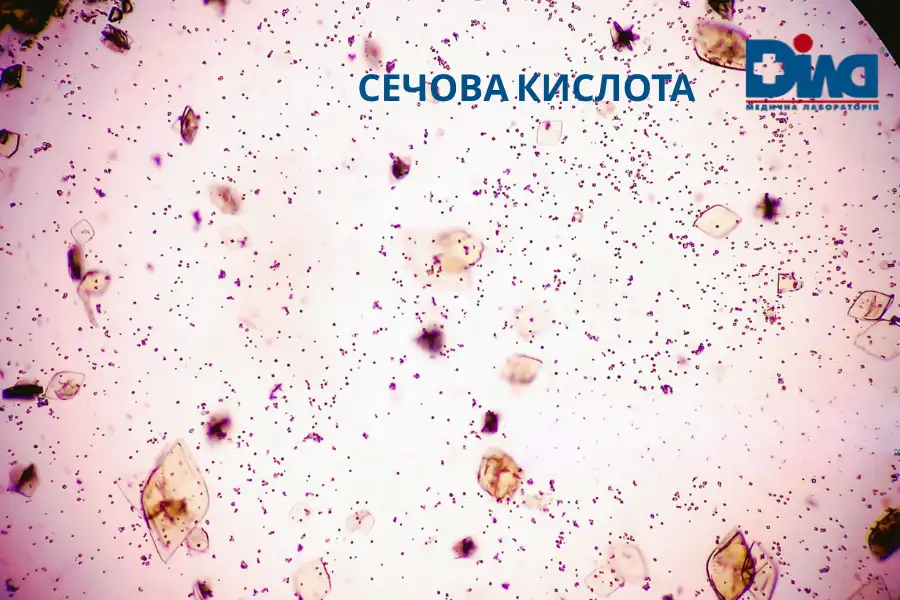Що таке сечова кислота і її роль в організмі Що таке сечова кислота і її роль в організмі