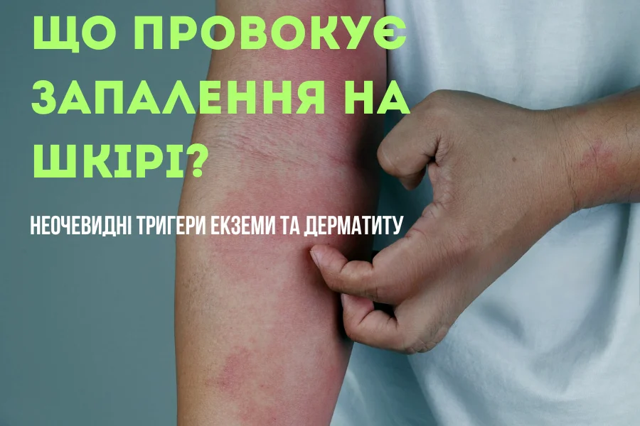 Що провокує запалення на шкірі? Неочевидні тригери екземи та дерматиту Що провокує запалення на шкірі? Неочевидні тригери екземи та дерматиту