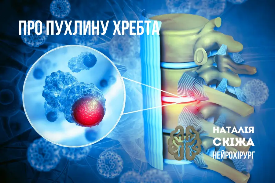 Пухлину хребта діагностувати можна на МРТ та КТ Пухлину хребта діагностувати можна на МРТ та КТ