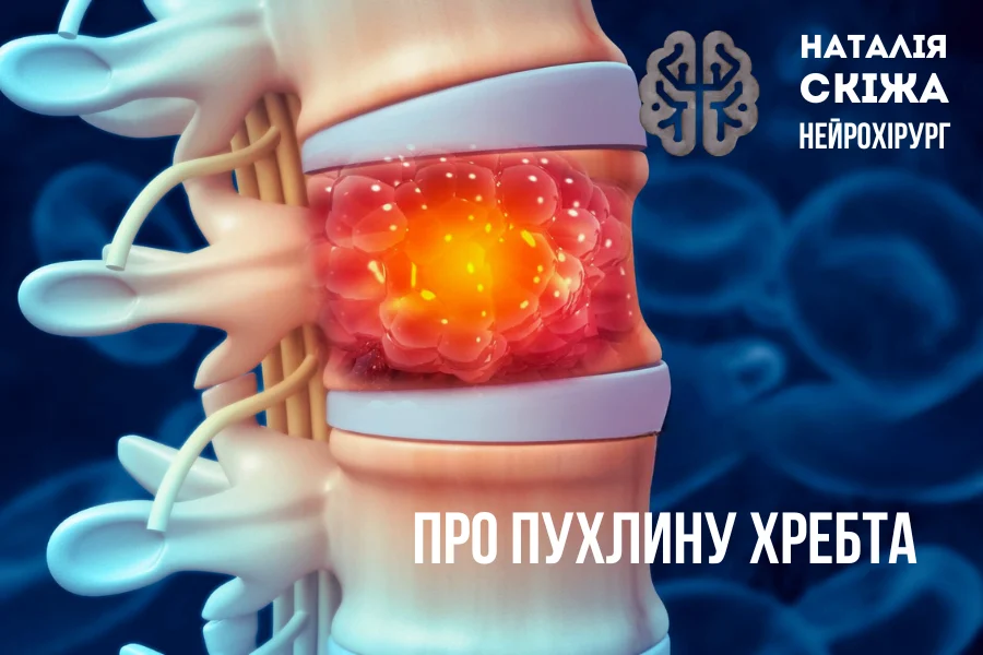 Коли тривалий біль у спині може бути симптомом пухлини хребта Коли тривалий біль у спині може бути симптомом пухлини хребта