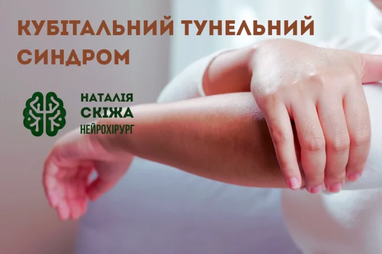 кубітальний тунельний синдром 1