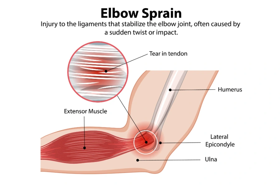 Причини виникнення кубітального тунельного синдрому