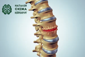 Остеопоротичні переломи хребта: причини, діагностика та лікування
Остеопоротичні переломи хребта: причини, діагностика та лікування
- Нейрохірург Наталія Скіжа 2025
