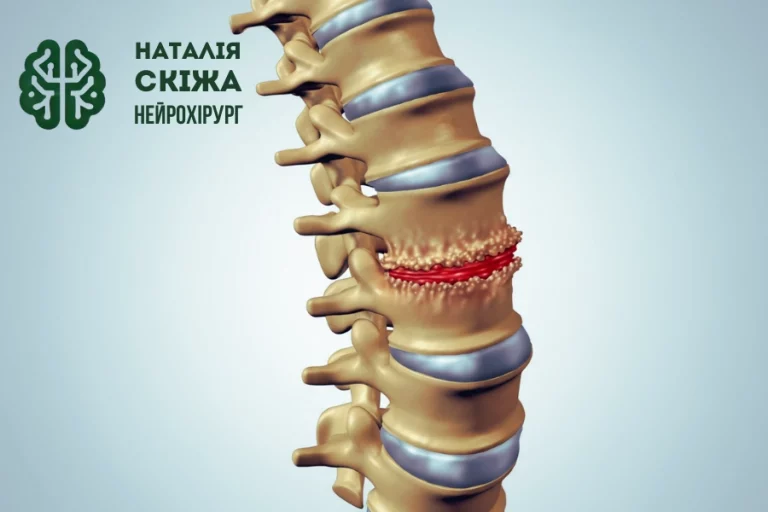 Остеопоротичні переломи хребта: причини, діагностика та лікування  - Нейрохірург Наталія Скіжа Київ