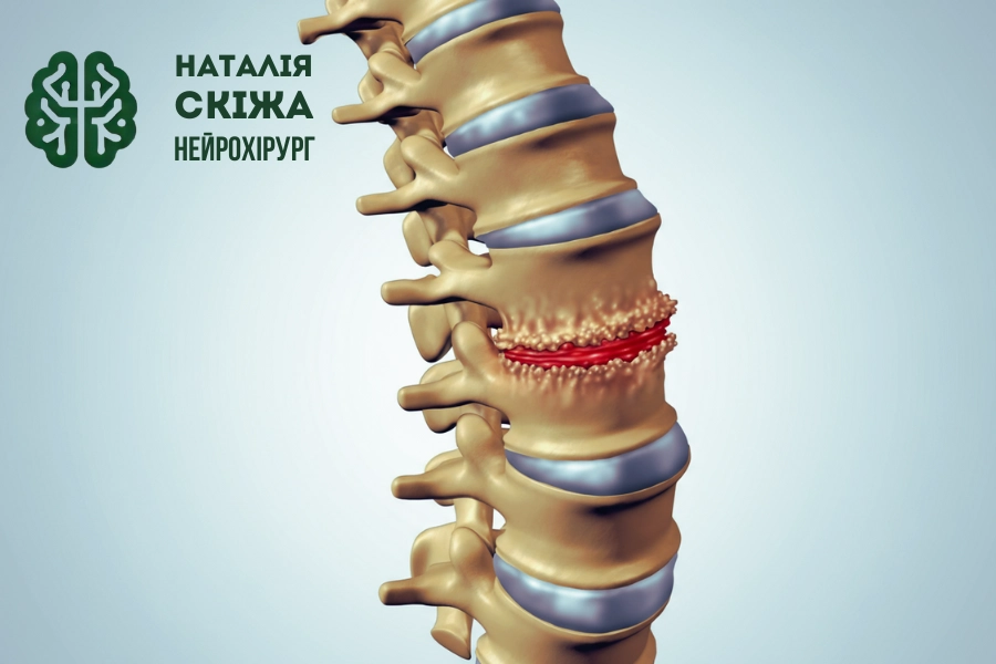 Остеопоротичні переломи хребта: причини, діагностика та лікування  - Нейрохірург Наталія Скіжа Київ