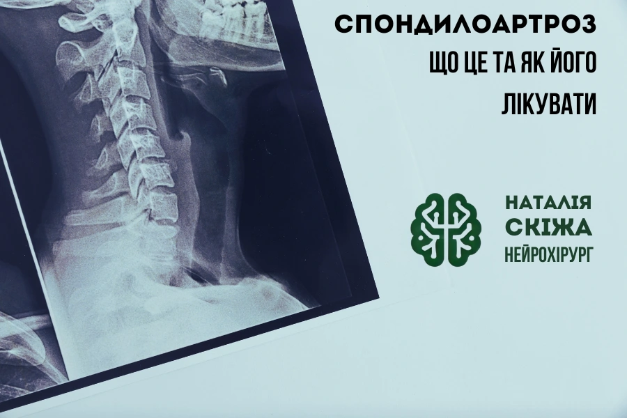 Спондилоартроз Наталія Скіжа Київ 5
